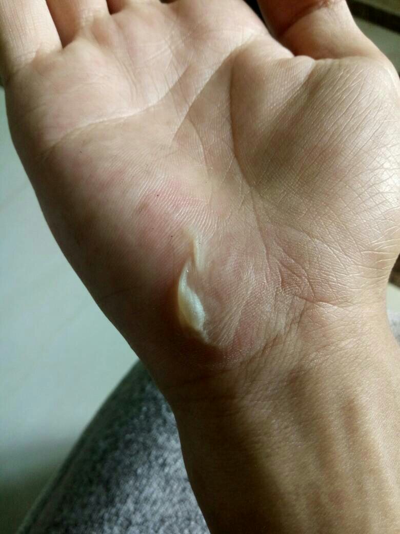 手上磨出水泡如何处理